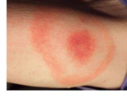 Preventing Lyme Disease